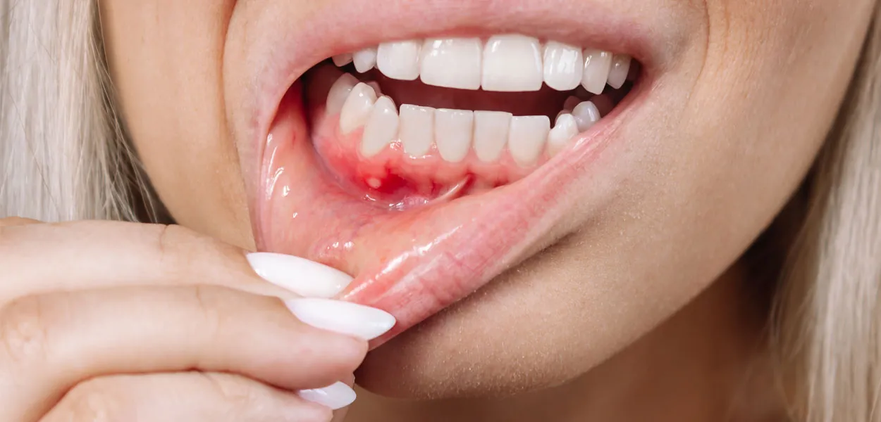Signs You May Have a Dental Abscess or Tooth Infection
