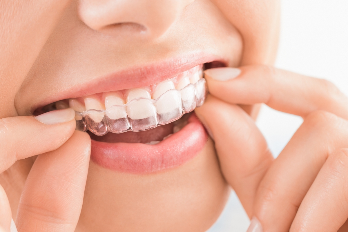Why Invisalign Treatment is Gaining Popularity Among Adults in Fitchburg