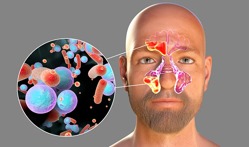 Sinusitis vs. Dental Abscess: What's Causing Your Facial Pain?