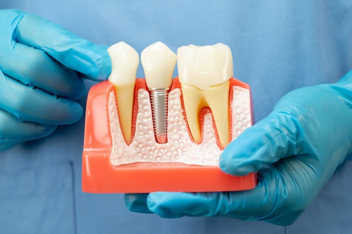 dental implants in Leominster