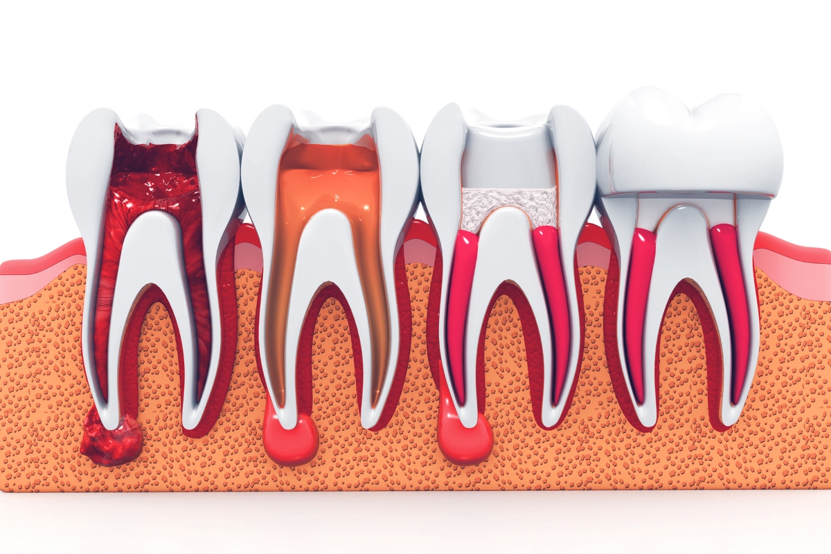 Root Canal Treatment Recovery: What to Expect After Your Procedure?