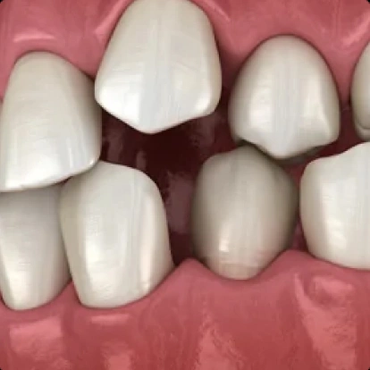 Img-porcelain-veneers-Irregularly Shaped Teeth