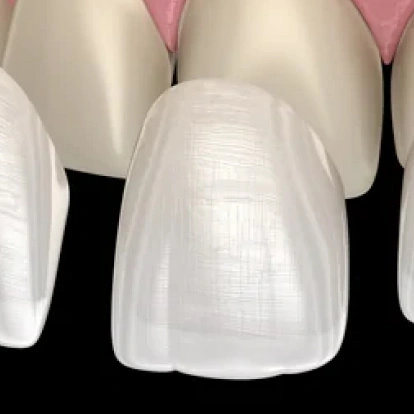 Img-porcelain-veneers-Tooth Discoloration
