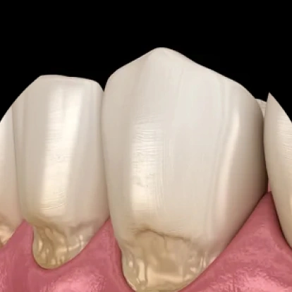 Img-porcelain-veneers-Worn Down Teeth