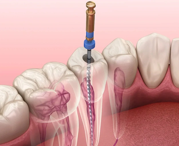 Img-root-canal