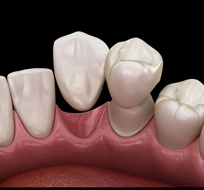Dental Crown Procedure