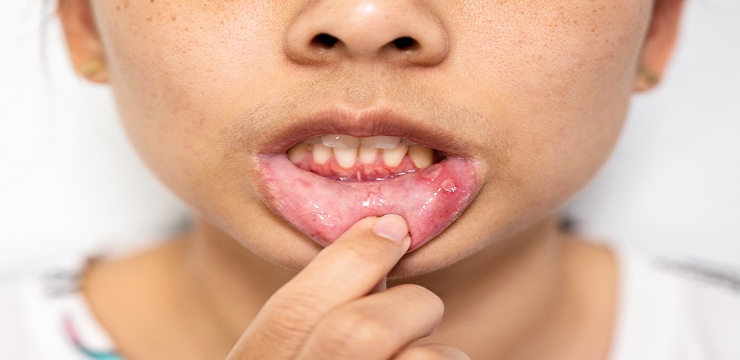 child with Gum Disease